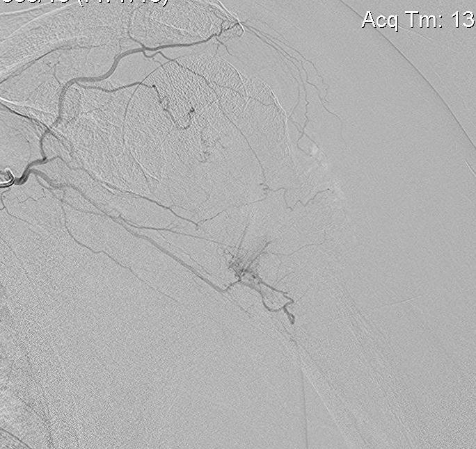 Shoulder RCC Embolisation